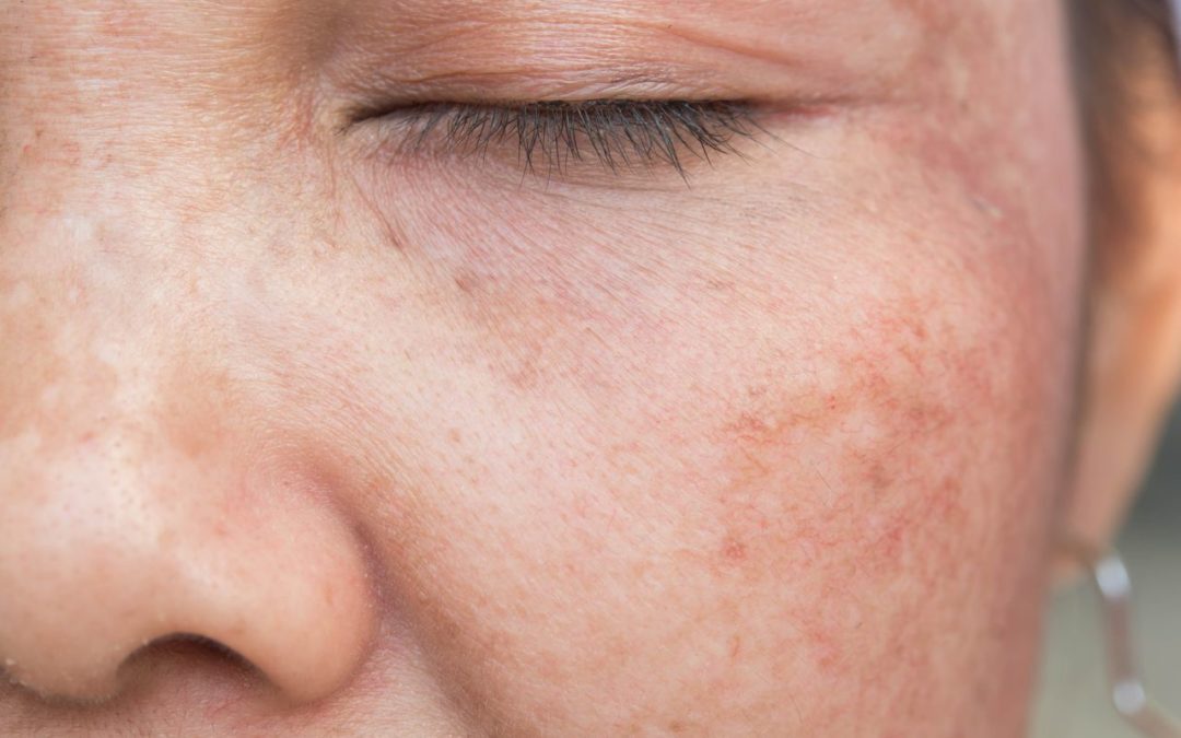 Understanding Sun Damage: Prevention and Treatment at The Lift Bar Med Spa