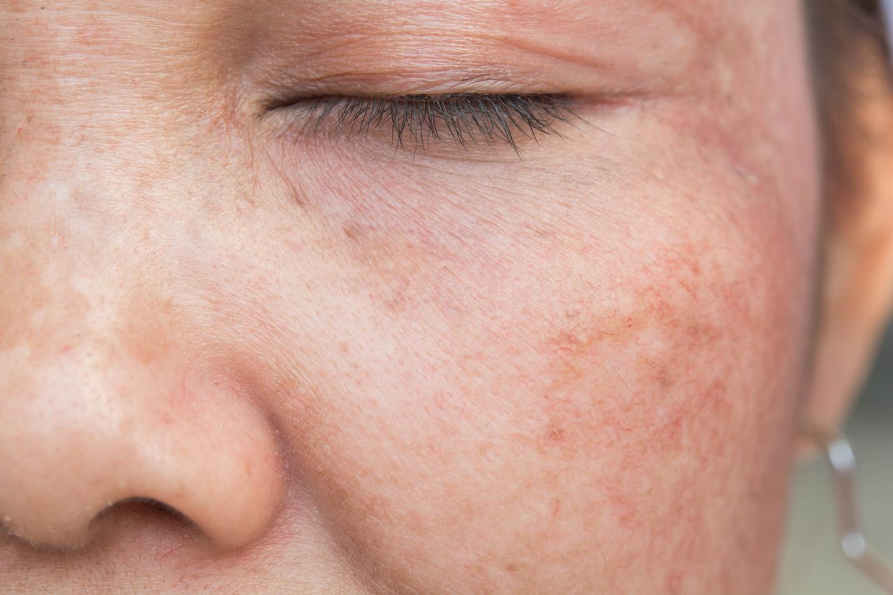 age or sun spots | The Lift Bar Med Spa