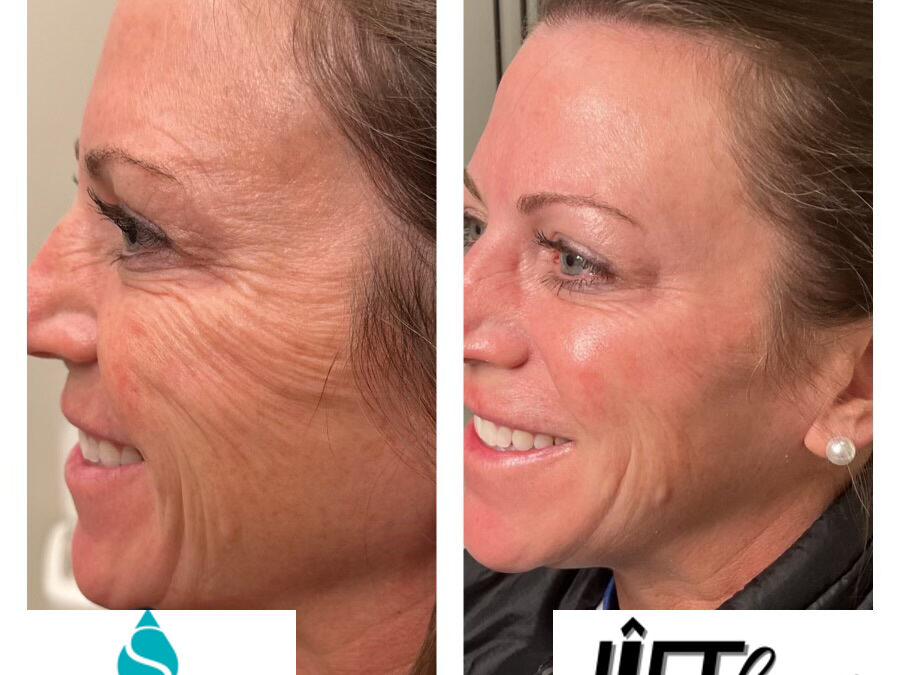 Unlocking Youthful Radiance with Skinvive by Juvederm at The Lift Bar Medspa, Nicholasville KY