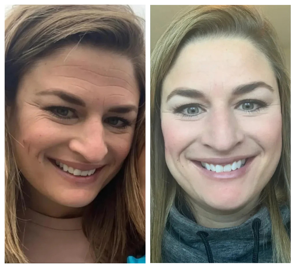 Before-and-after photos of a smiling woman; left image shows forehead wrinkles and lines, right image shows smoother skin after treatment.