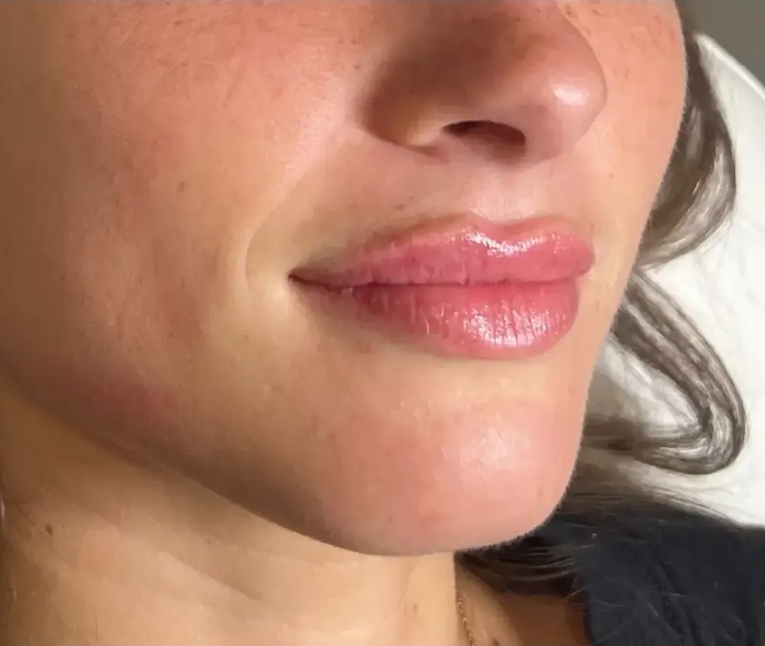 Dermal Fillers After (1)
