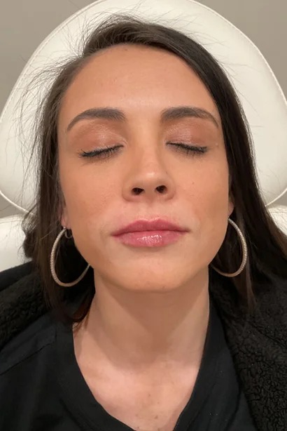 Dermal Fillers ( After ) (1)