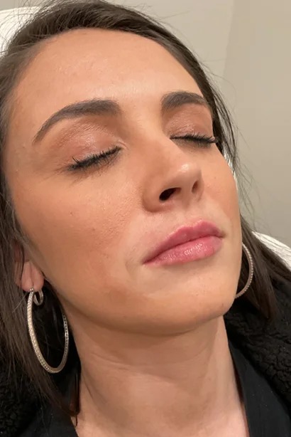 Dermal Fillers ( After )(2)