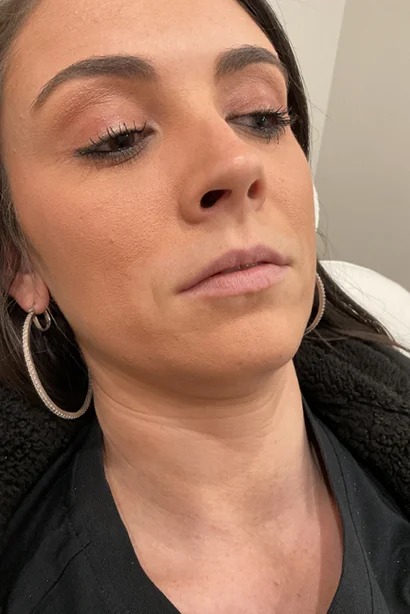 Dermal Fillers ( Before )(2)