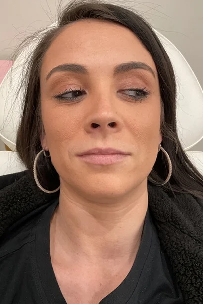 Dermal Fillers ( Before)(1)