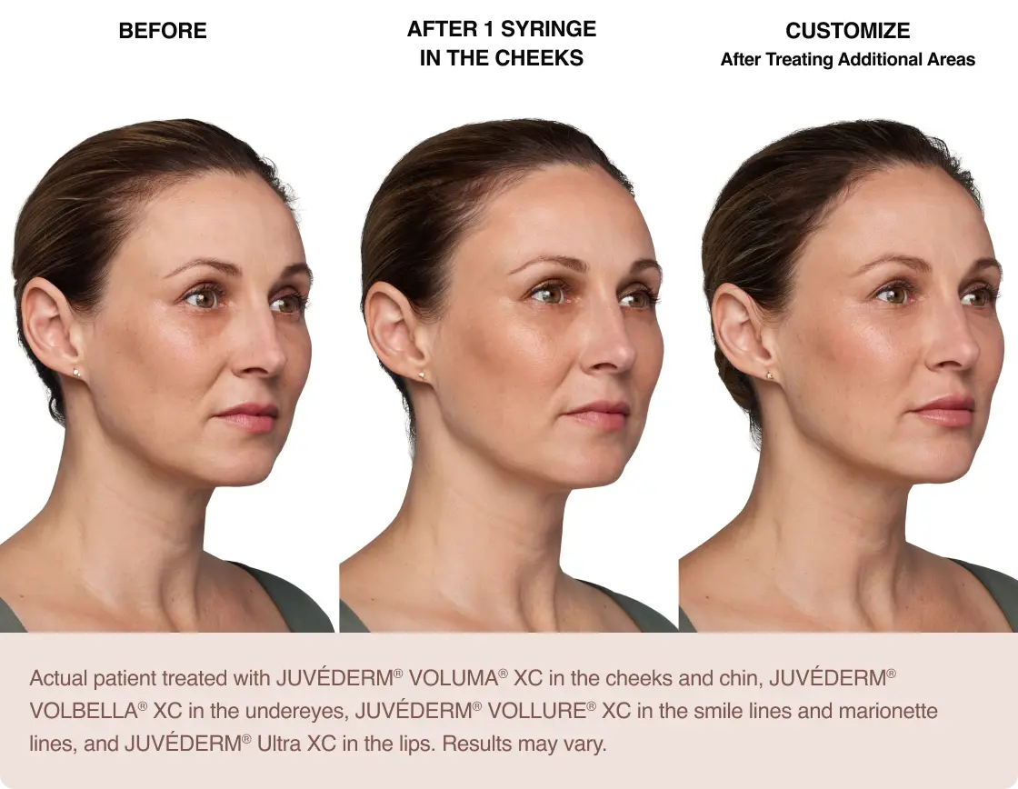 Juvederm®