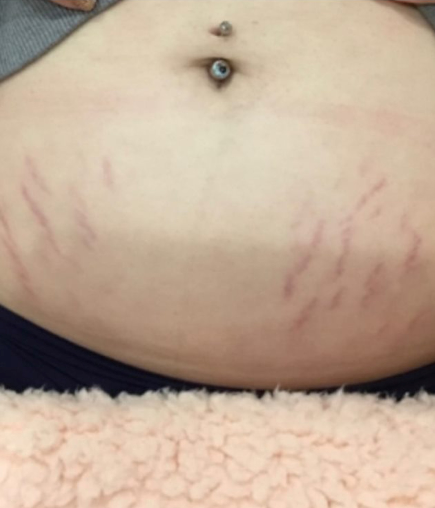 Close-up of bare midriff showing a navel piercing and faint scars across the lower abdomen.